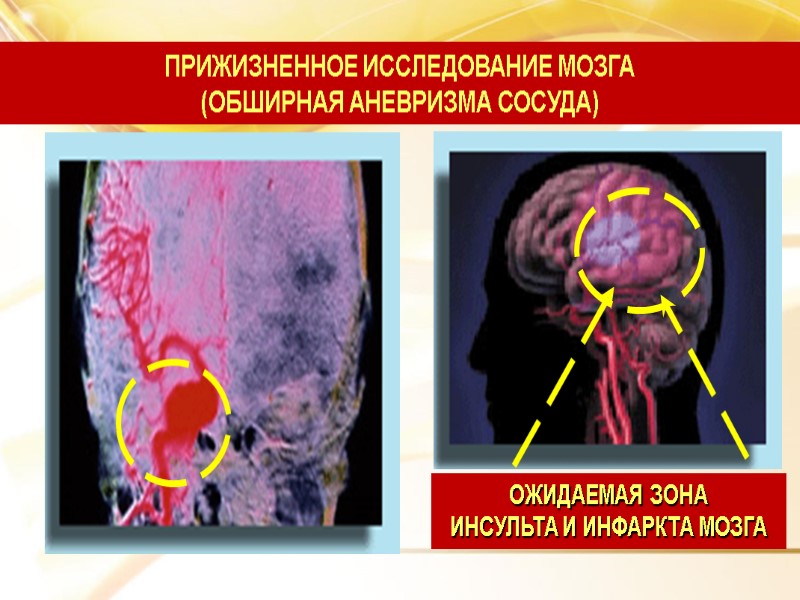 ПРИЖИЗНЕННОЕ ИССЛЕДОВАНИЕ МОЗГА (ОБШИРНАЯ АНЕВРИЗМА СОСУДА) ОЖИДАЕМАЯ ЗОНА  ИНСУЛЬТА И ИНФАРКТА МОЗГА